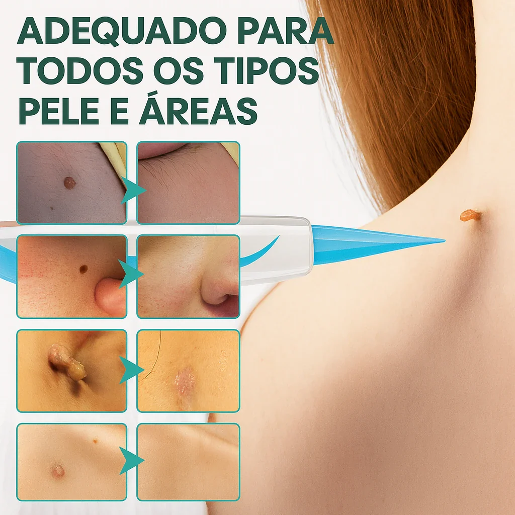 Meu Tag - Kit para remoção de verrugas na pele 4